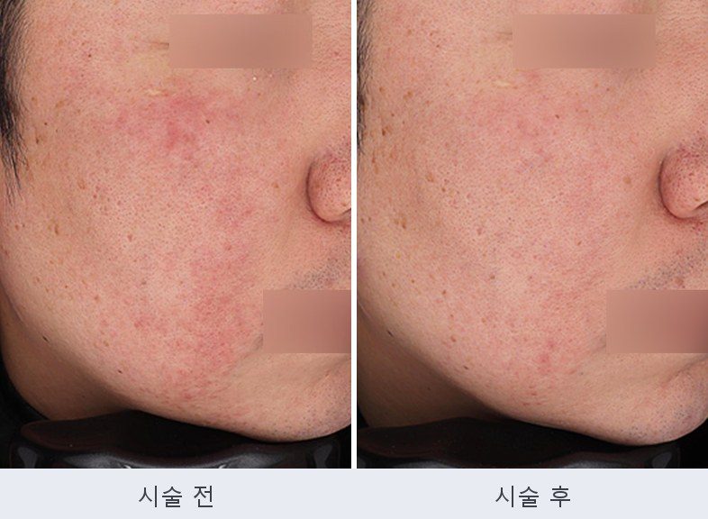 홍조