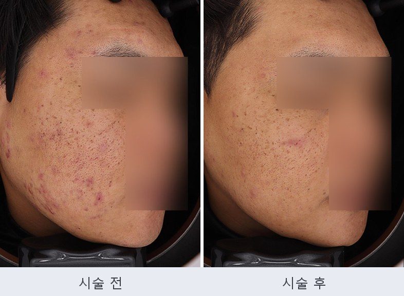 여드름 붉은자국